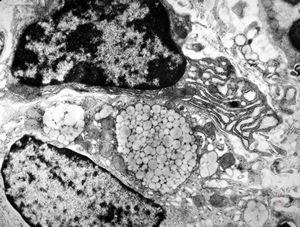 Whipple disease - lipid malabsorption